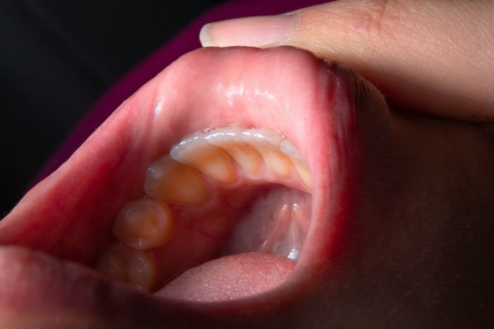 Zubní implantáty fotka